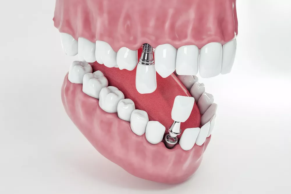 Single & Multiple Teeth Implants