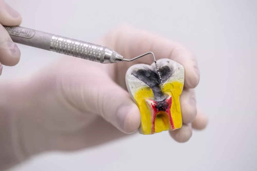 Pit And Fissure Sealants