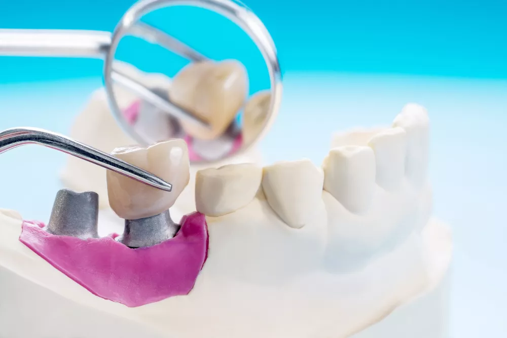 Dental Crown & Bridges